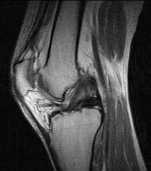 kneecap fracture