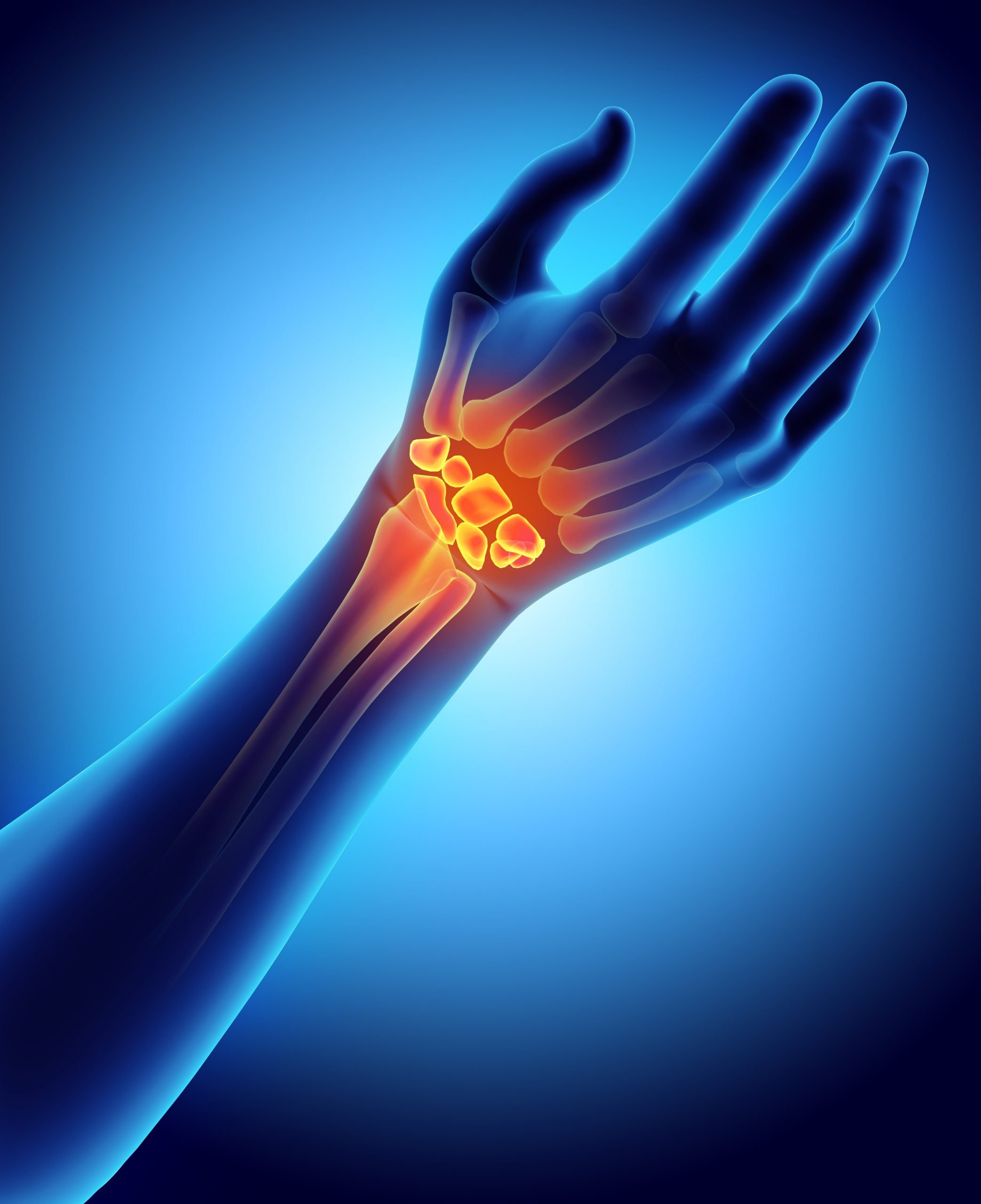 Carpal Tunnel Syndrome - AOA Orthopedic Specialists