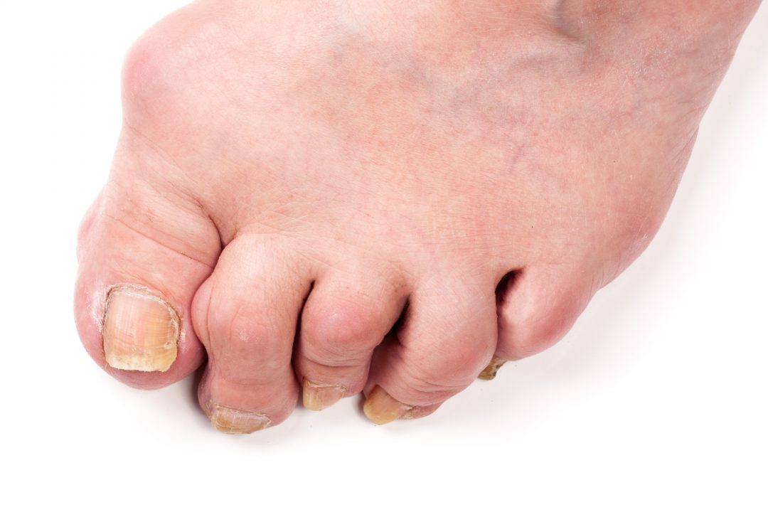 What Does It Mean To Have A Hammer Toe