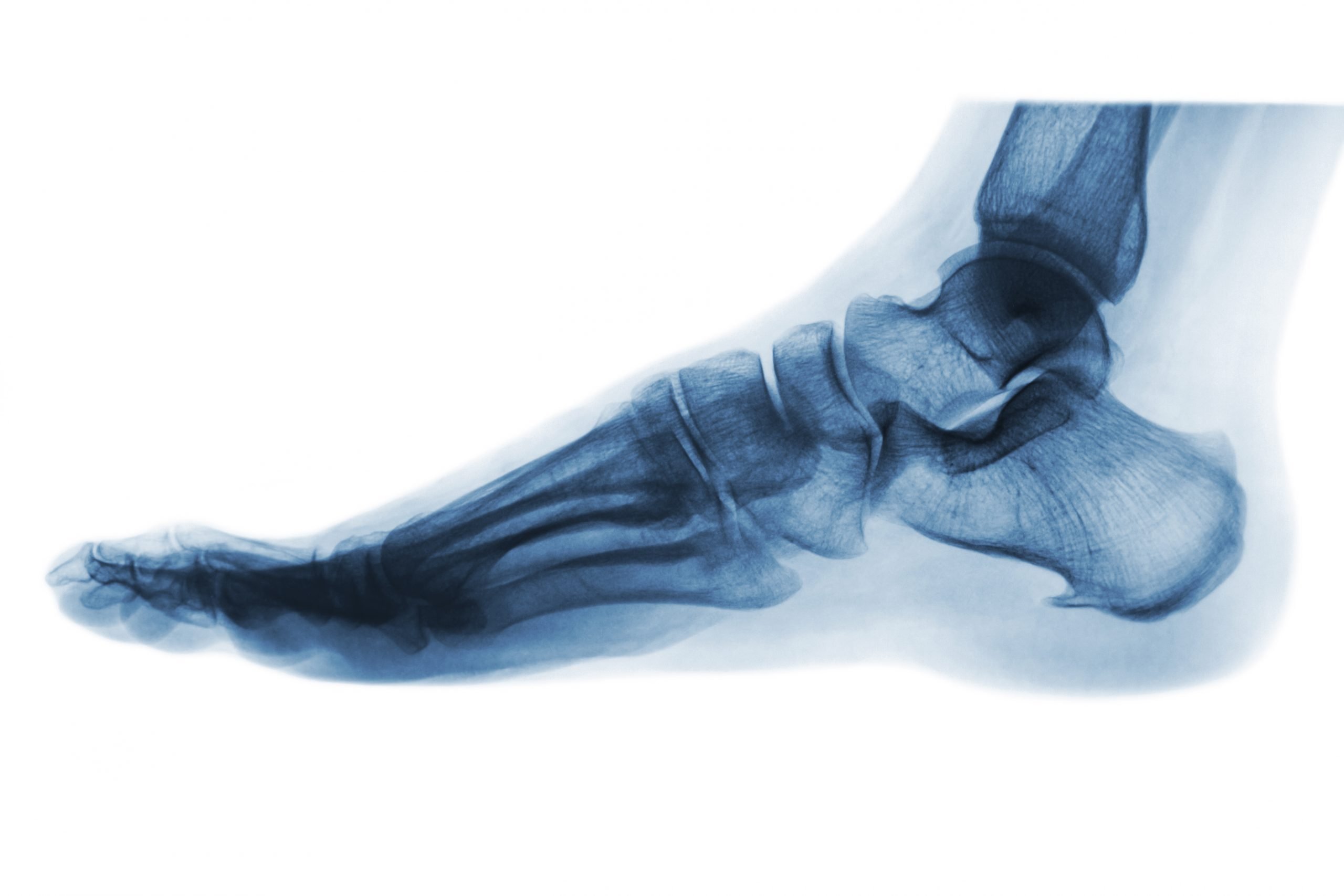Can You Break an Ankle Without Realizing It?: Arlington/Mansfield