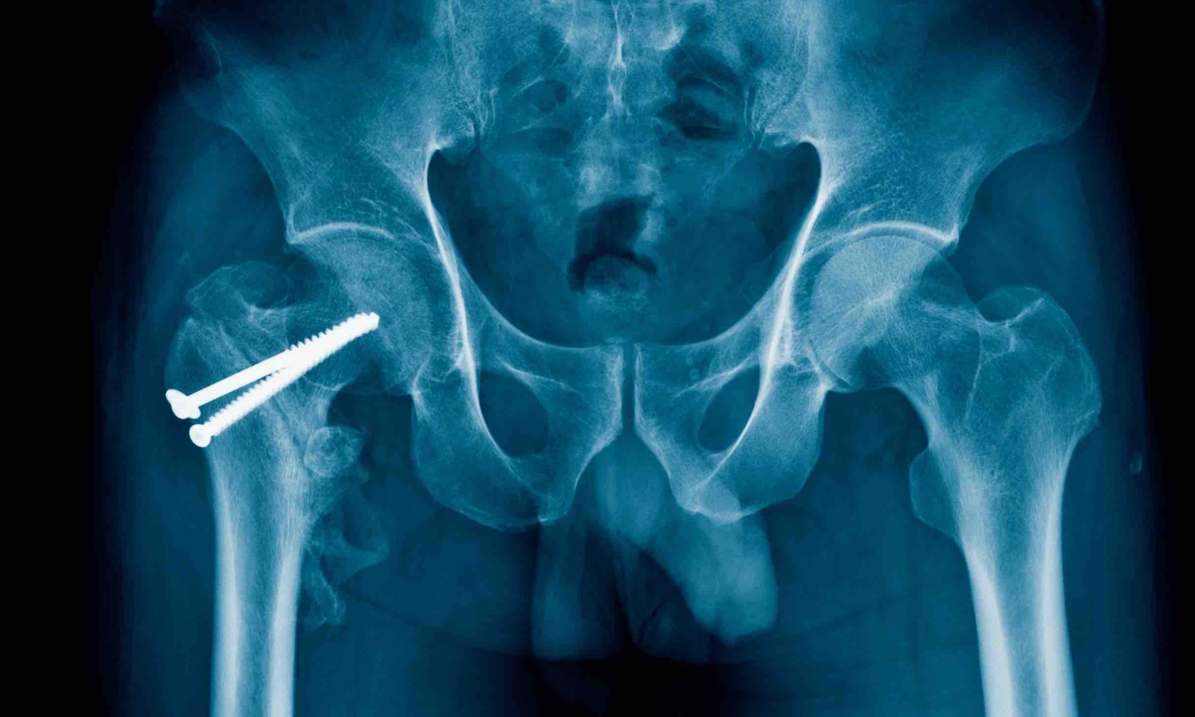 Fixation Hip By Screw X ray Image Of X ray Hip Fracture And Post 