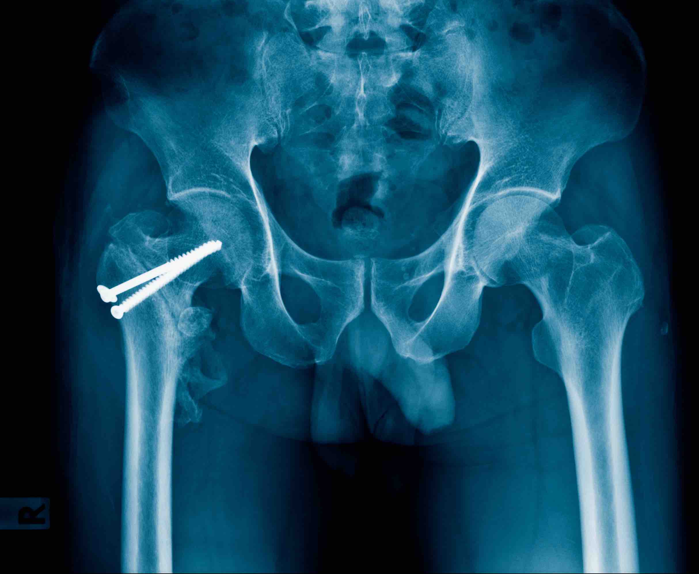 hip-fracture-treatment-with-surgical-screws-arlington-orthopedics