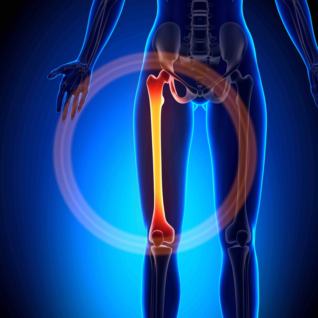 Femur or lower extremities issues