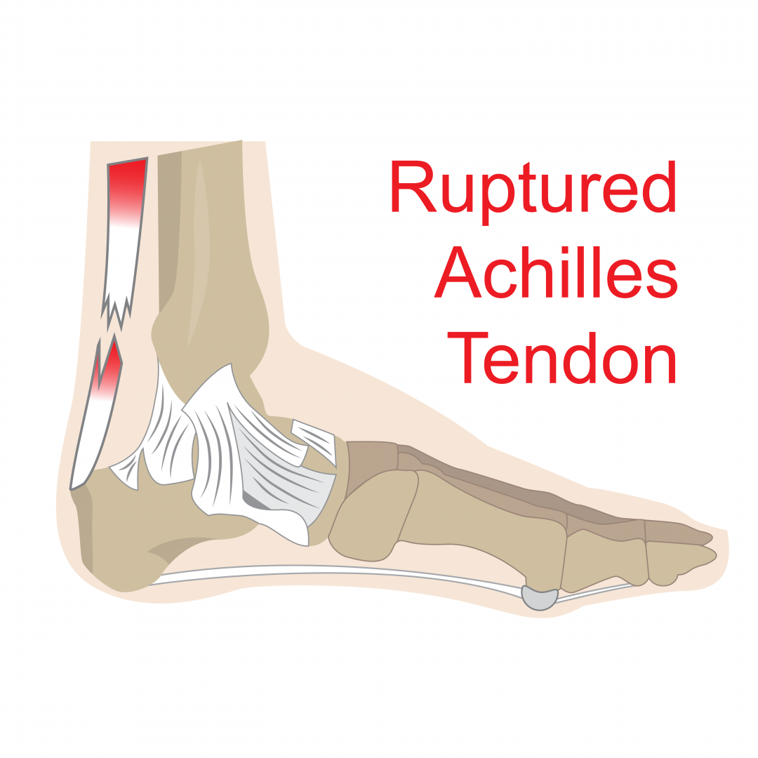 WHAT IS A ACHILLES TENDON RUPTURE?