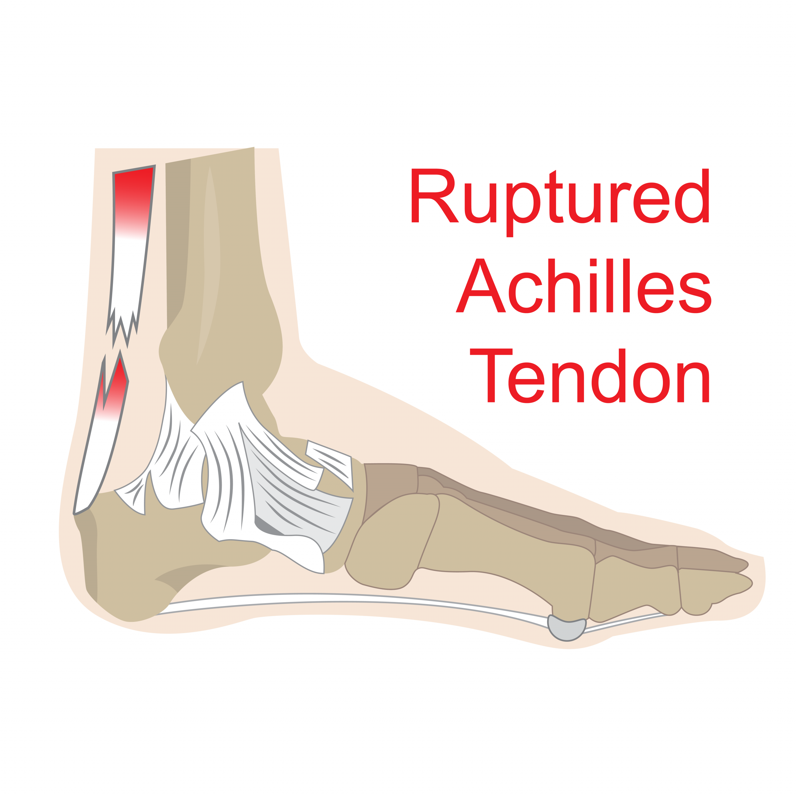 Achilles Tendon Repair - AOA Orthopedic Specialists