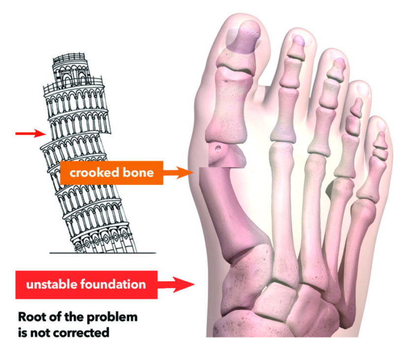 regular bunion correction