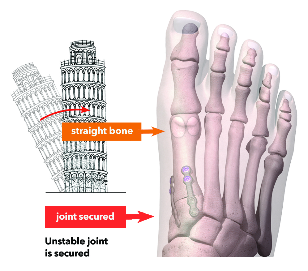 lapiplasty bunion correction